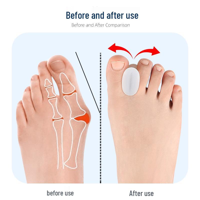 Bunion Corrector & Silicone Toe Separator for Men & Women - Wearable in Shoes