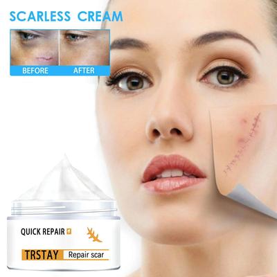 Haut-Wundcreme, brennende, verblassende Creme, chirurgische Reparatur, Narbenpflege, Hautaufhellungscreme