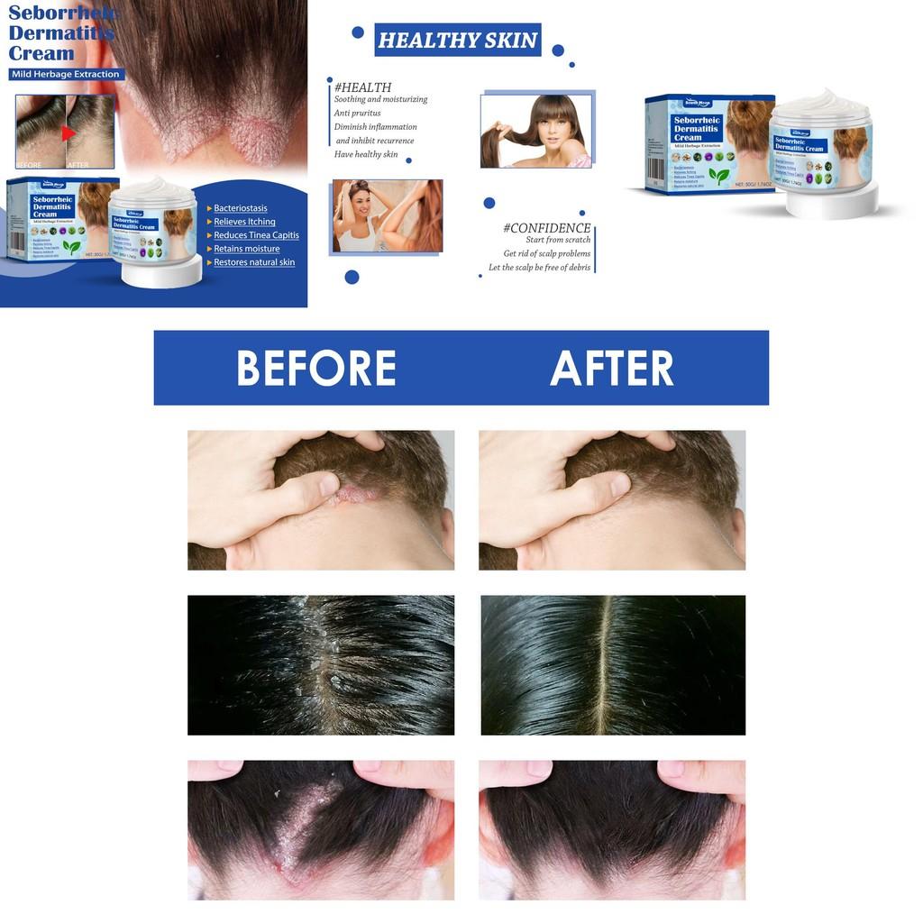 South Moon Seborrheic Dermatitis Cream Effective Relief For Scalp And Skin Problems