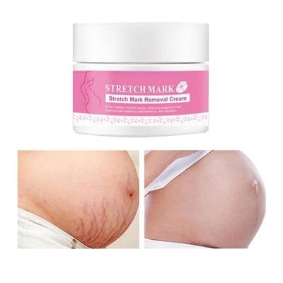 Entfernung Aknenarbencreme Fettnarbe Striae Gravidarum Behandlung