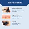 Man Matters Advanced Derma Roller 0,5 mm Titan-Nadeln zur Stimulierung des Bart- und Haarwuchses, Sicher und Einfach zu Bedienen