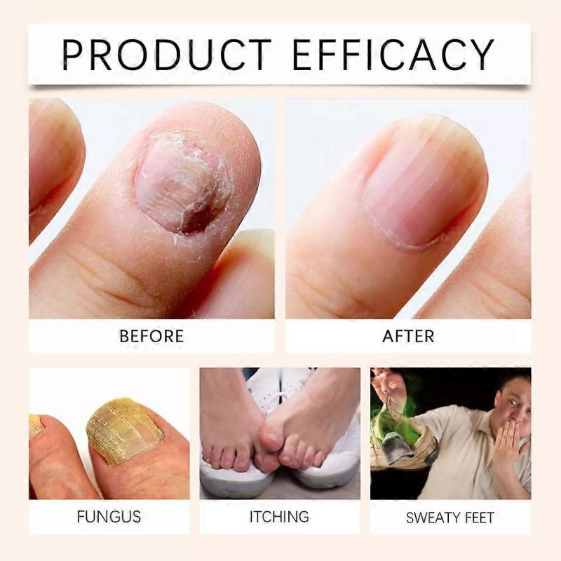 3pcs Bee Venom Nail Treatment Serum Toenail Serum Liquid Nail Growth and Repair 20ml