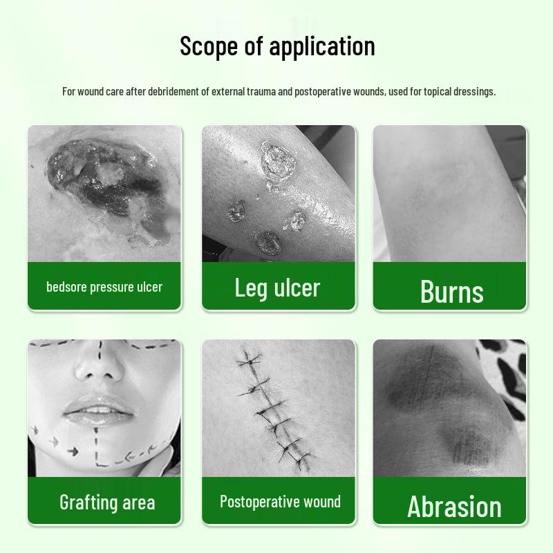 Tuo Neng Alginate Dressing for Healing Wounds: Pressure Ulcers, Bedsores, Cuts, Abrasions, Burns, Scalds, and Ulcers