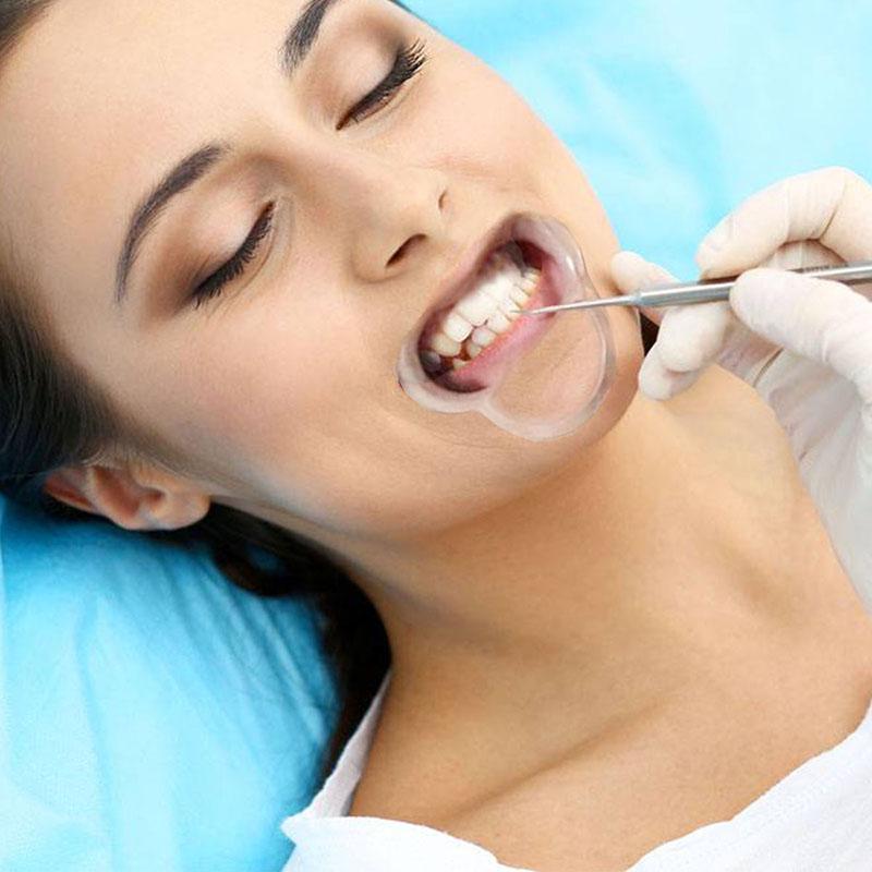 15 Pcs Dental Teeth Whitening Cheek Lip Retractor Mouth Opener C Shape 3 Sizes Mouth Expanders