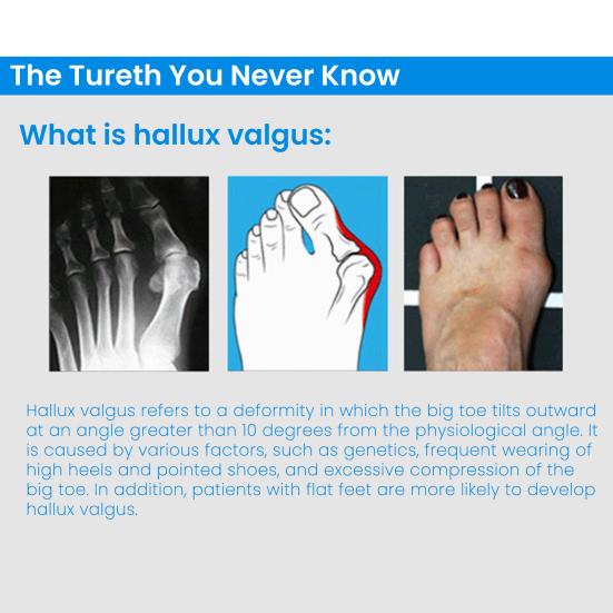 Bunion Corrector Toe Separator Adjustable Hallux Valgus Splint for Women Men Breathable Toe Stretcher for Pain Relief Toe Alignment