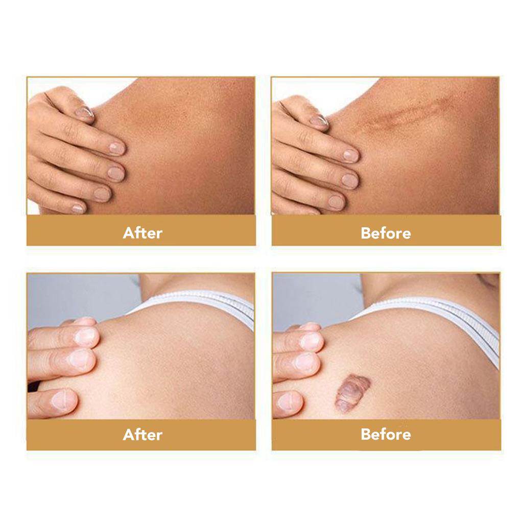 Silicone Scar Tape Roll Waterproof Self Adhesive Cuttable Gentle Scar Tape Roll for Full Body 4 X 150cm