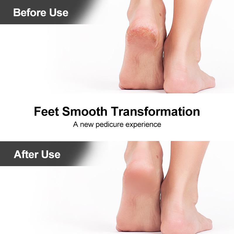 Stainless Steel Foot Exfoliation Tool - File, Brush, Grinder, Stone, and Scrubber Combo.