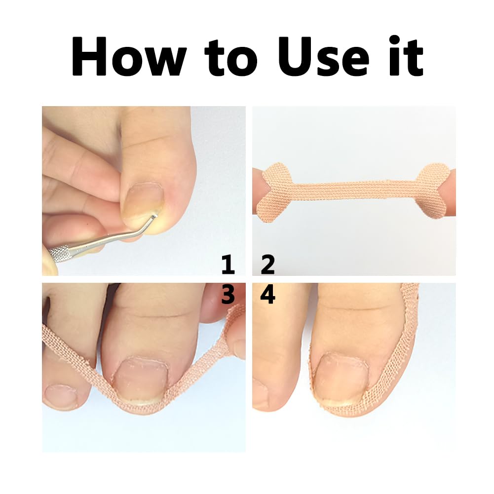 Nail Correction Stickers Ingrown Toenail Corrector Patches Paronychia Treatment Recover Corrector Pedicure Tools