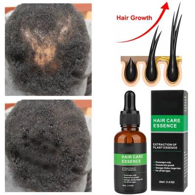 Essence de croissance des cheveux au gingembre pour améliorer la perte de cheveux, huile de croissance des cheveux, 30 ml