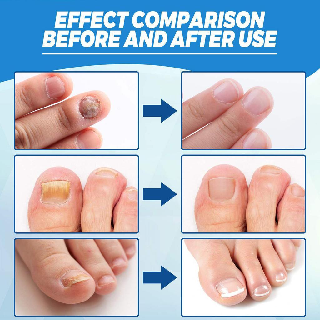 Tužka s modrým světlem na nehty, Šedá tužka na nehty, Snadné použití, Odstraňovač zápachu, Péče o nehty