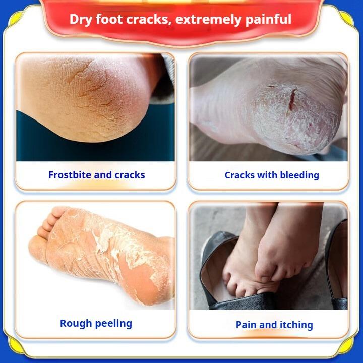 Cracked Feet Cream, Cracked Heels, Cracked Cracks, Fungal Infections, Special Cream for Frostbite Cracks In Hands and Feet