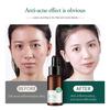 Tea Tree Acne Treatment Serum Shrinking Pores Oil Control Glycerin Anti Scar Whitening Moisturizing Skin Care