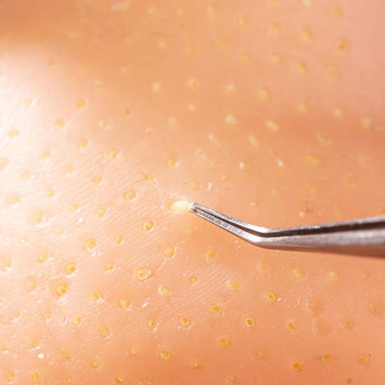 2 st Pormaskklämleksak Fyllning Fett DIY Stressavlastning Pormask Ansiktssimulator Silikon Akne Näsa Påfyllningsfett Tillbehör