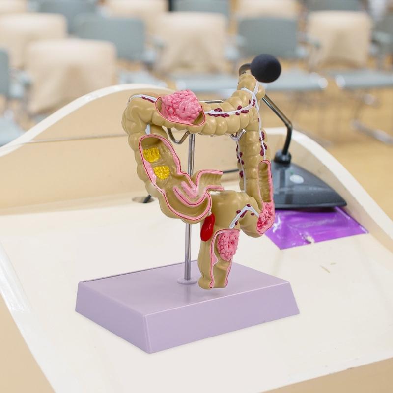 Menschliches Dickdarmmodell für Anatomie, Medizin, Lehrmodell, Pathologien des Dickdarmmodells für Studium und Ausstellung