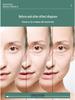 Gold Microneedle DRS40: Professional Salon Essence for Local Care