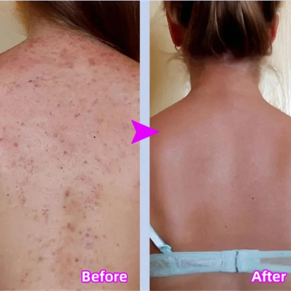 Body Whitening Cream Keratosis Pilaris Treatment Bumpy Rough Chicken Follicle Skin Repair Strawberry Legs Removal Dry Skin Care