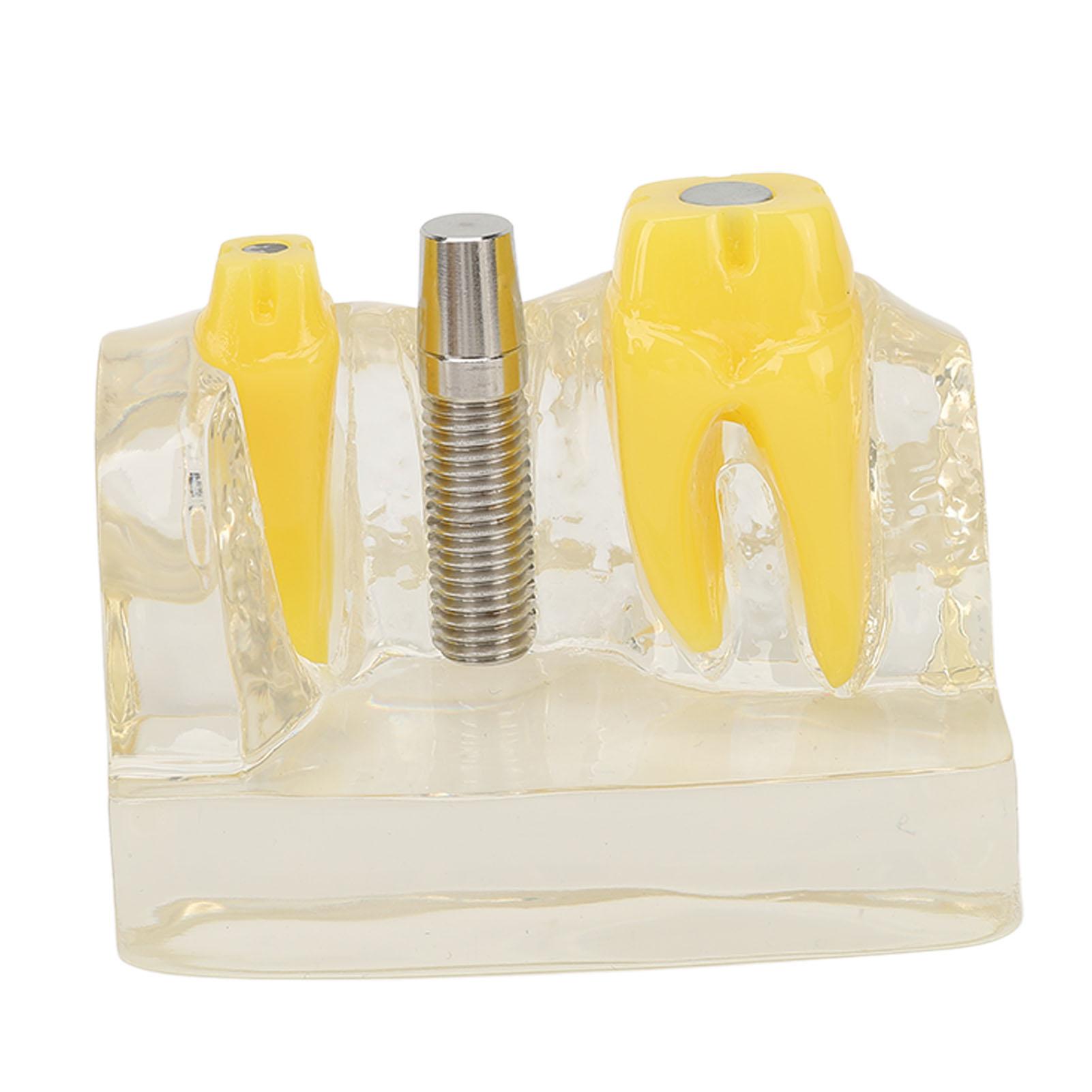 

Модель имплантата зубов Прозрачная стоматологическая обучающая исследовательская демонстрационная модель зубов