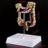 Human Colorectal Lesion Model Pathological Anatomy Colon Diseases Intestine Medical Teaching Learning Tool