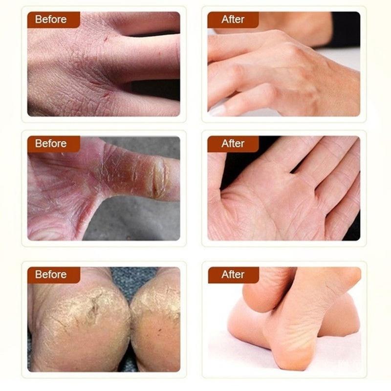 Koňský olej Regenerační krém na ruce a nohy Krém na péči o nohy Beriberi a puchýře na svědivé nohy zabraňují popraskání