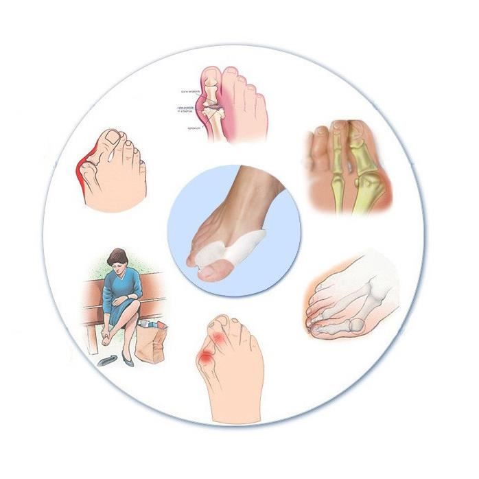 Silikonová ortéza Hallux Valgus