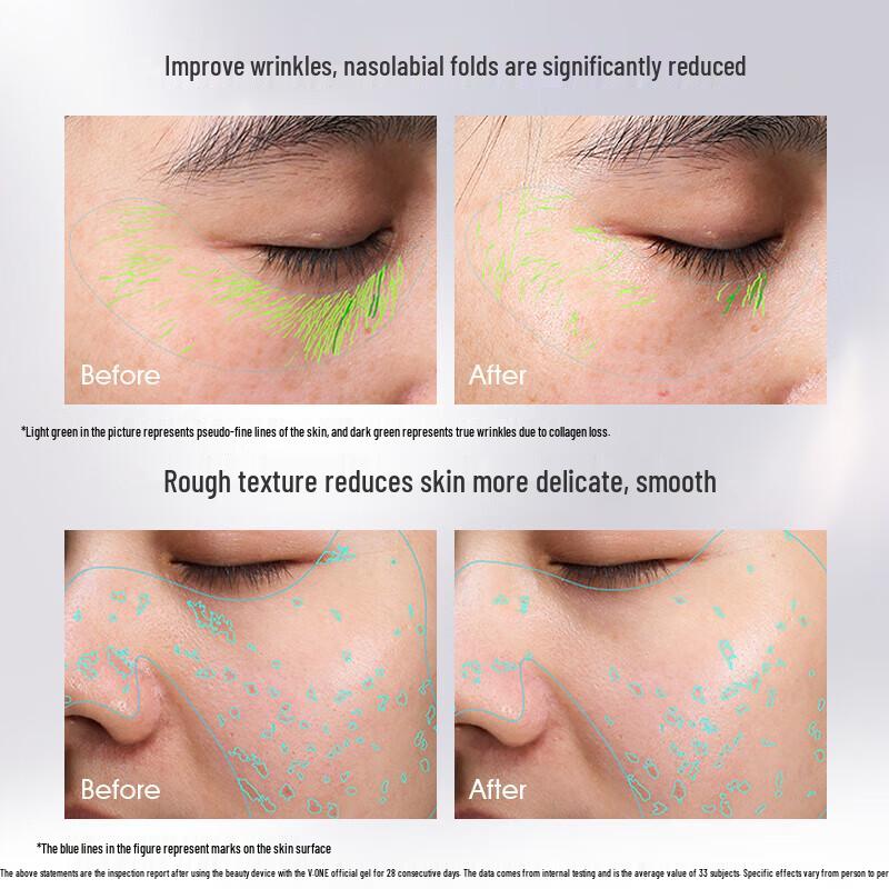 V.ONE ACE-II Pro3.0 Home RF Beauty Device