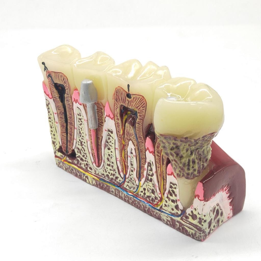 1 Pc Dental Teeth Common Pathologies Model Teaching Model Tooth Dentist for Medical Science Teaching Dental Communication Model