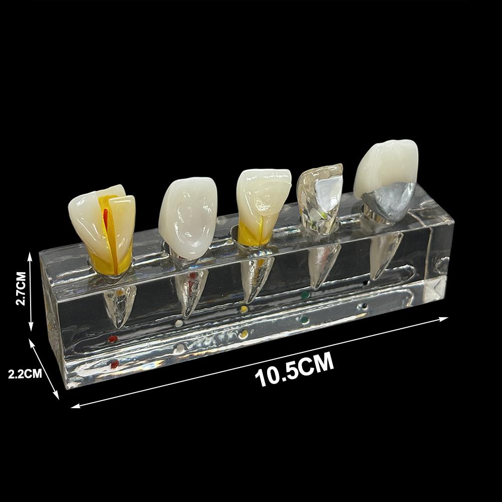Dental Pulp Restoration Pathological Model Detachable Teeth Dissecting Premolar Teeth Cavity Filling Dentist Material