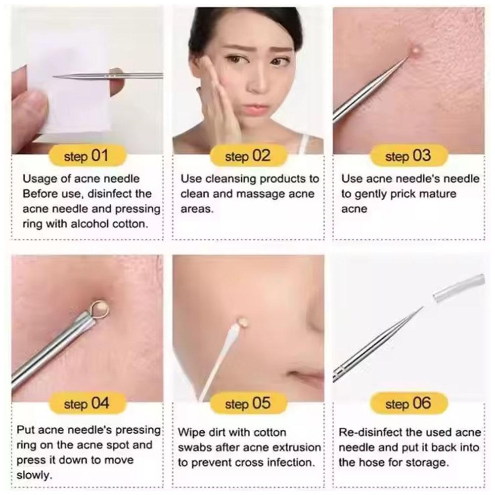 1pc Carbon Steel Antibacterial Blackhead Remover Tool Acne Salon Face Remove Pimples Spots Beau L7C8