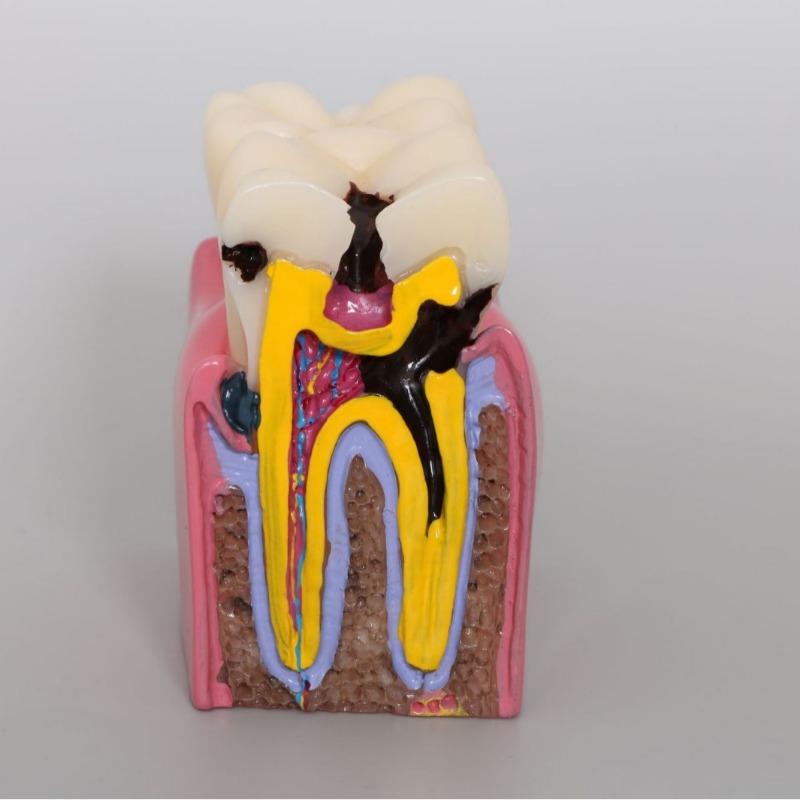 Modello Carie Dentale 6 Volte Malattia Denti Modello Dentale per Dimostrazione Dentale Modello Insegnamento Dentista Laboratorio Dentale Ricerca Orale