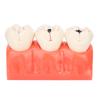 Dental Caries Model Tooth Decay Demonstration Model Simulation Detachable Teeth Model