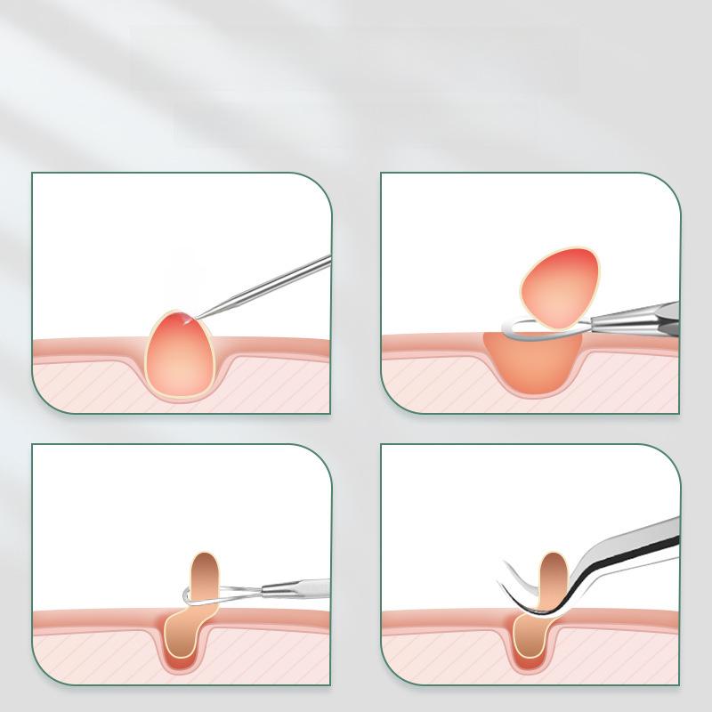 Stainless Steel Blackhead Remover: Acne Needle & Tweezers Set