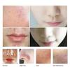 Ultrasonic Skin Scrubber Blackhead Pimple Removal Face Pore Vibration Cleanser Instrument