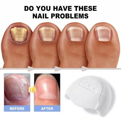 Nail Fungus Cleaning Device with Infrared Blue Light Therapy Home Use Nail-Fungus Remover for Toenail Fingernails Onychomycosis