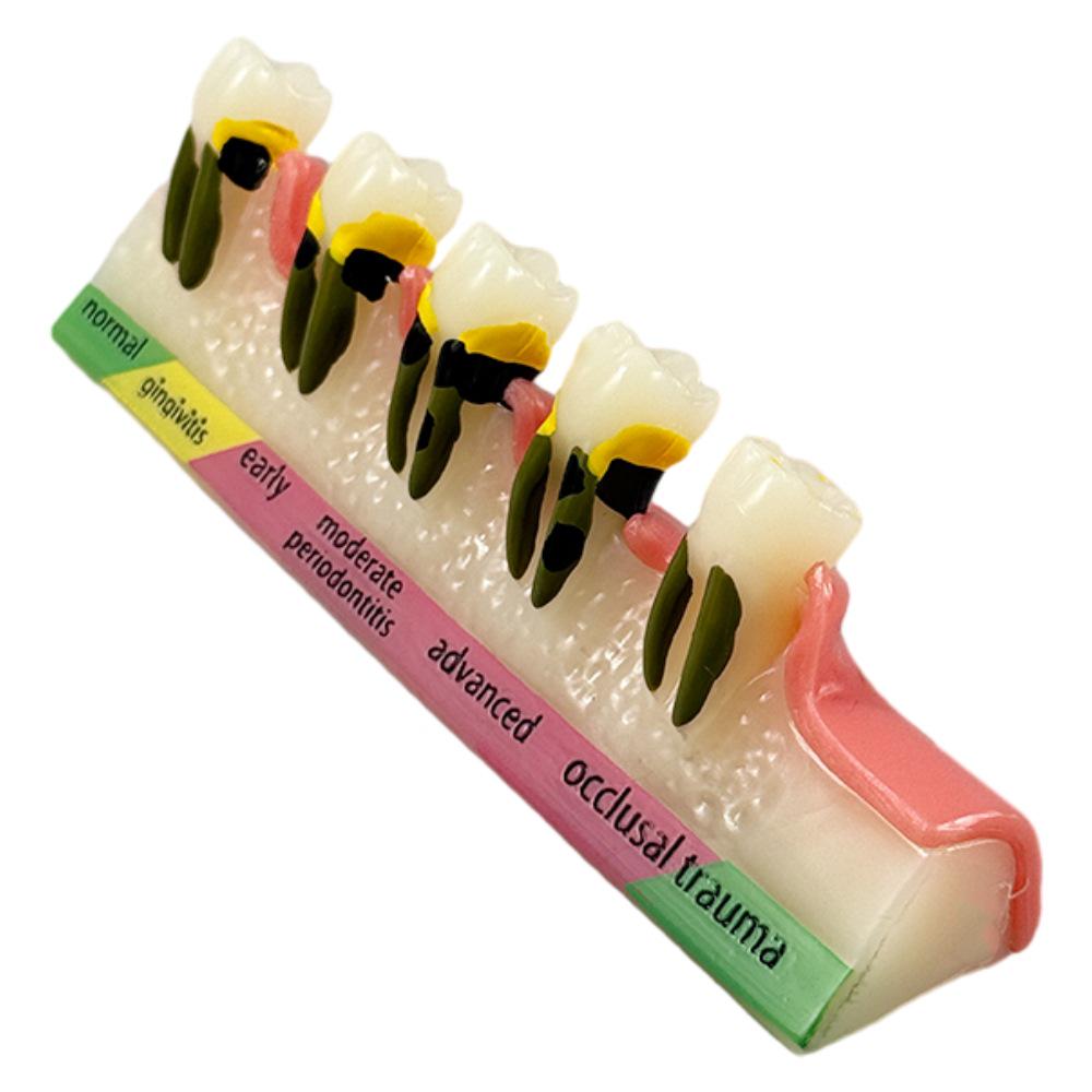 Dental Implant Teaching Model & Toothbrush Preparation Resin Mold