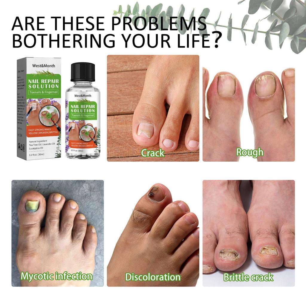 Toenail Fungus Care, FastActing Nail Care Liquid For Fungus Under & Around  Restores The Healthy Appearance Of Nails 30ml