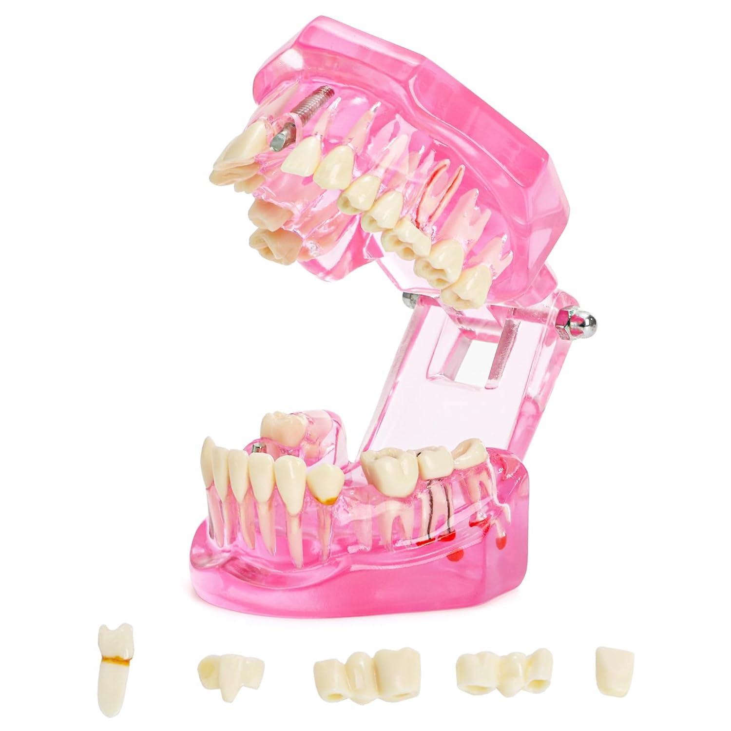 Disease Teeth Model with Dental Implant Bridge, Dental Model for Patient and Dental Student Education, Teeth Typodonts Analysis Demonstration Teeth розовый