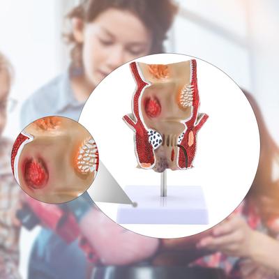 Human Rectal Hemorrhoid Pathology Model, Educational Display Tool, Intuitive Teaching Tool for