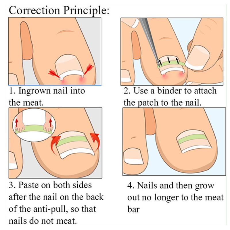 1Pcs Nail Correction Stickers Ingrown Toenail Corrector Patches Invisible High Strength Auxiliary Patch Paronychia Treatment