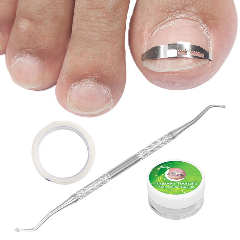 Buy Ingrown Toenail Correction Patch Pedicure Toenail Fixator Foot Care