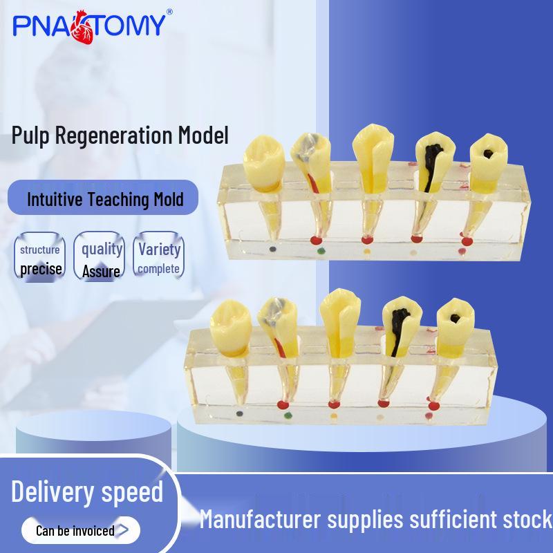 Dental Pathology and Restoration Model for Tooth Pulp Disease (Removable for Pulp Caries) 10.2*4*2.3cm