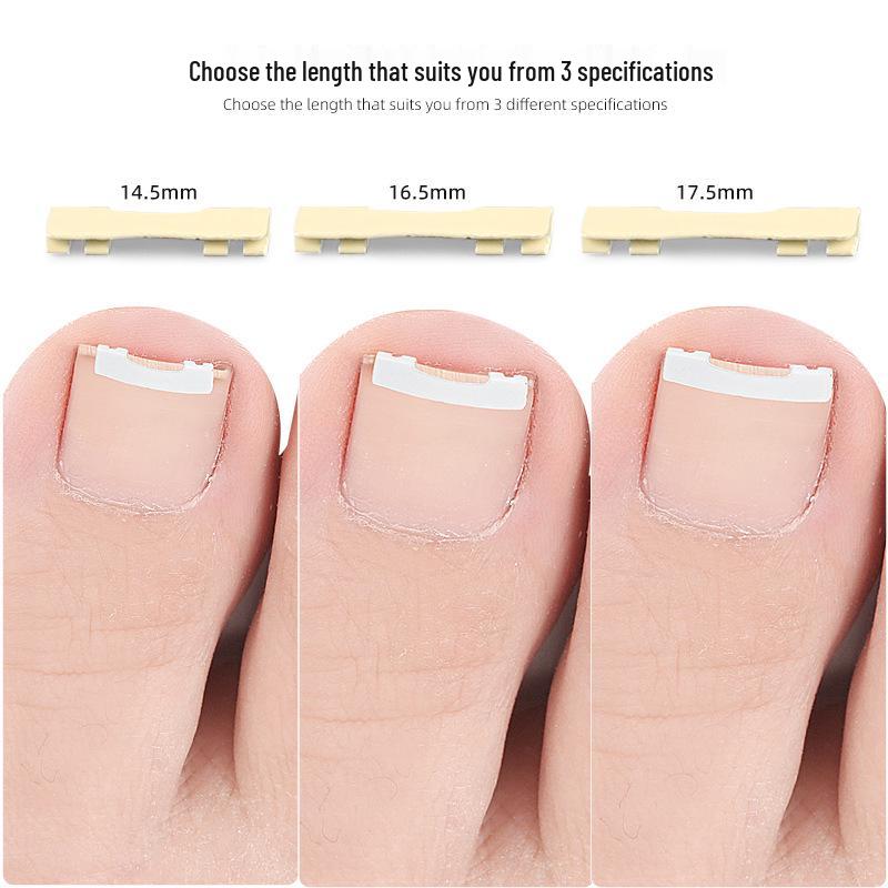 Nickel-Titanium Ingrown Toenail Corrector: Invisible, Wearable Nail Hook for Pain Relief