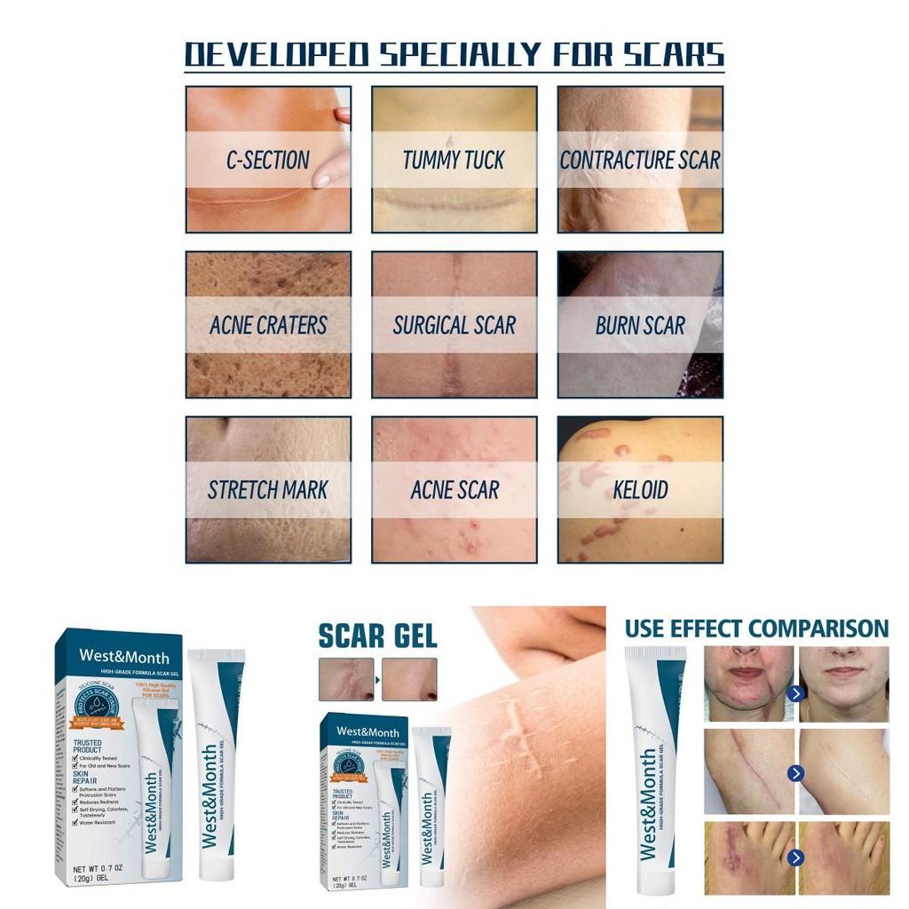 West Month Scar Diminishing Gel For Surgical Scars And Pregnancy Skin Care 20g