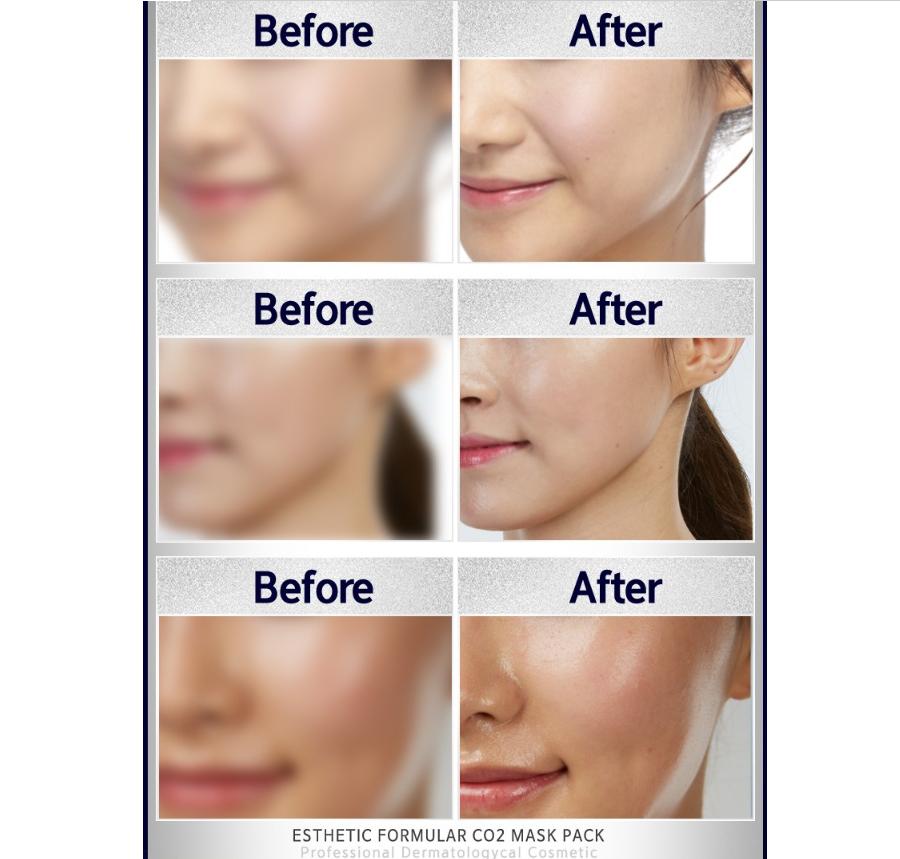 Aesthetic House CO2 Porenverengende Maskenpackung 5 Stück | Porenpflege & Straffung