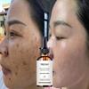 Dark Spot Corrector Cream, Ingredient, Enriching Skin Care For All Skin Tones, Melasma, Freckle, Sun Spot Improving For Women And Men