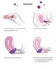 Medical-Grade Silicone Menstrual Disc - Reusable Alternative to Sanitary Napkins