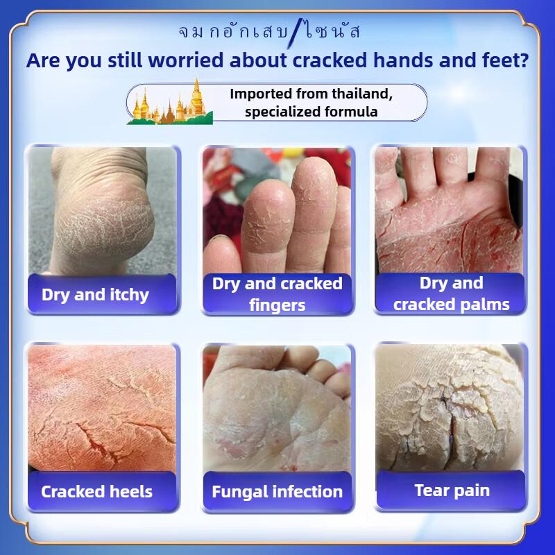 Cracked Hands and Feet Soothing Repair Cream, Focusing on Cracked Feet, Itching and Molting Improvement