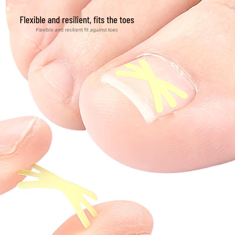Star-Shaped Ingrown Toenail Correction Patch