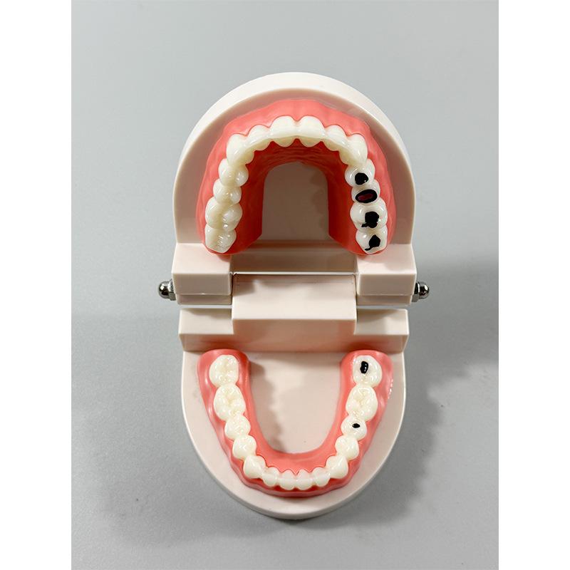 Прозора Знімна Повна Модель Щелепи з М'якими Яснами та Зубами для Підготовки до Імплантації