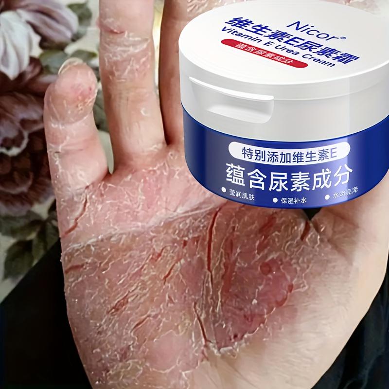 

Vitamin E Urea Cream Hydrating Moisturizing Body Lotion Anti-Freeze Anti-Dryness Nourishing Skin Care for Dry Skin 100g