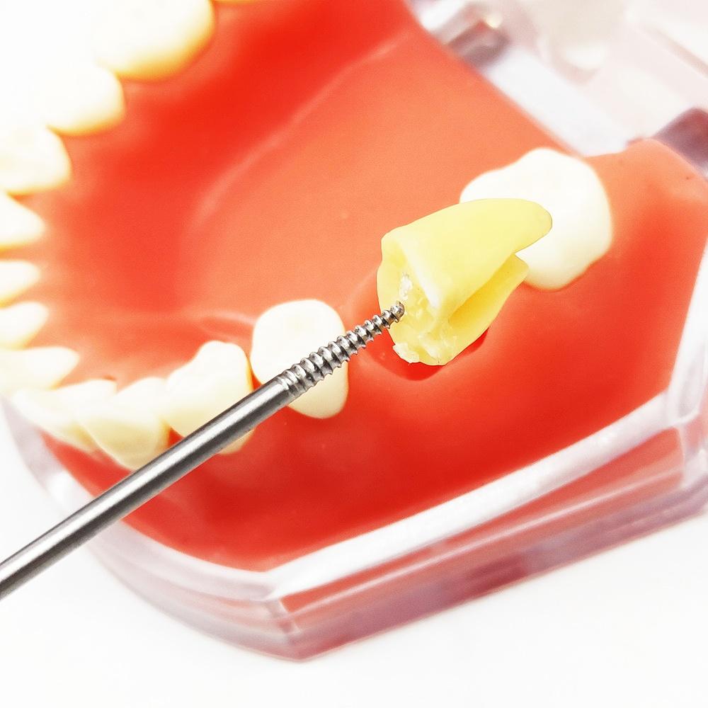 1 Stück oder 3 Stück Zahnwurzel-Zahnextraktionsschraube Zahnwurzelschraubenextraktor Apikale Wurzelfragmente Werkzeuge Zahnärztliche Werkzeuge für gebrochene Wurzeln Medizinisch